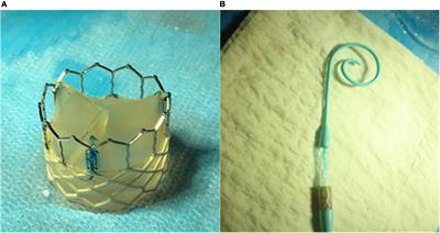 Temporal, biomechanical evaluation of a novel, transcatheter polymeric aortic valve in ovine aortic banding model